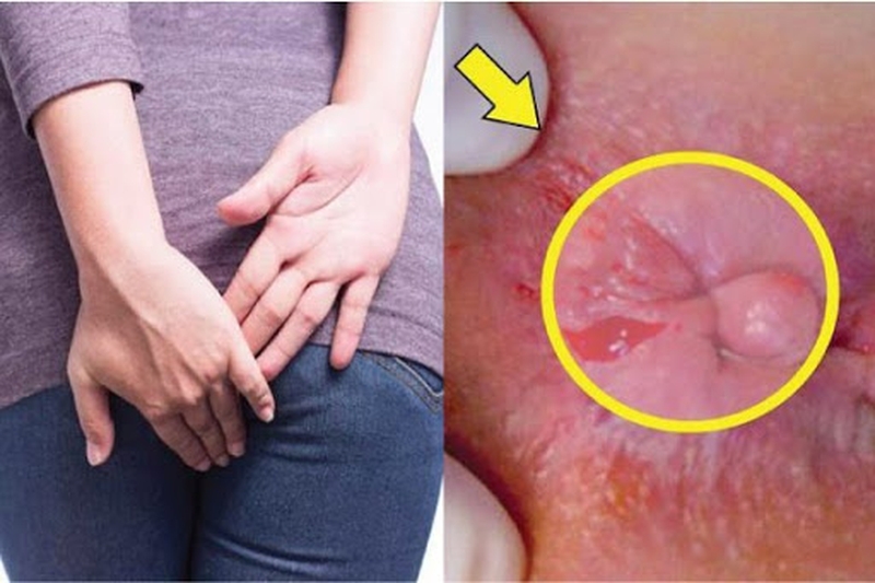 Cách phòng bệnh trĩ hiệu quả mà bạn nên biết 2