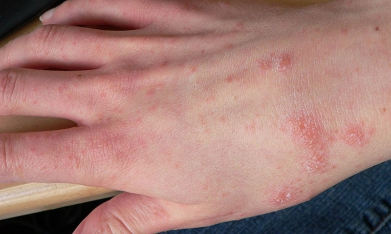 Cách chữa viêm da cơ đị hạn chế bệnh tái phát nhiều lần 1