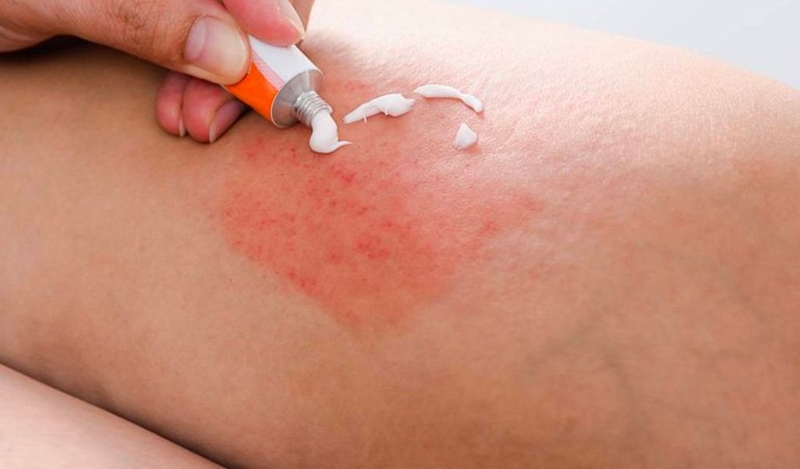 Cách chữa viêm da cơ đị hạn chế bệnh tái phát nhiều lần 2