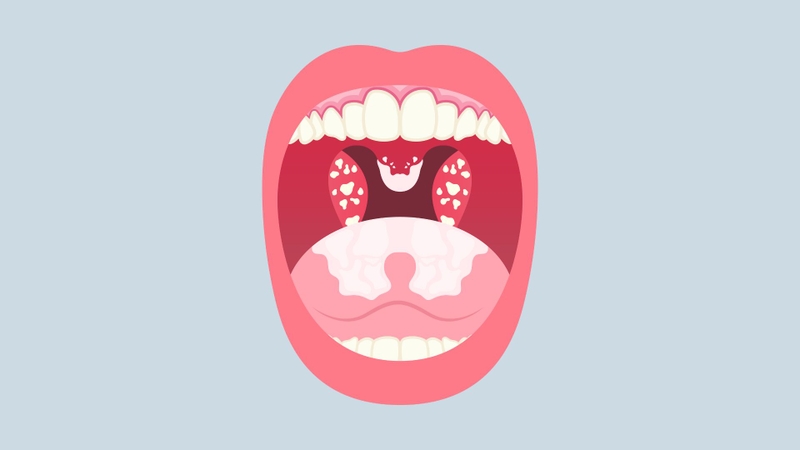 Cách chữa viêm họng hạt hiệu quả theo y khoa và biện pháp hỗ trợ tại nhà 1