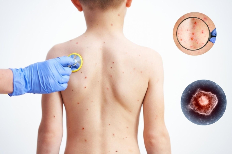 Cách để khắc phục tình trạng bị thủy đậu ngứa không ngủ được 1