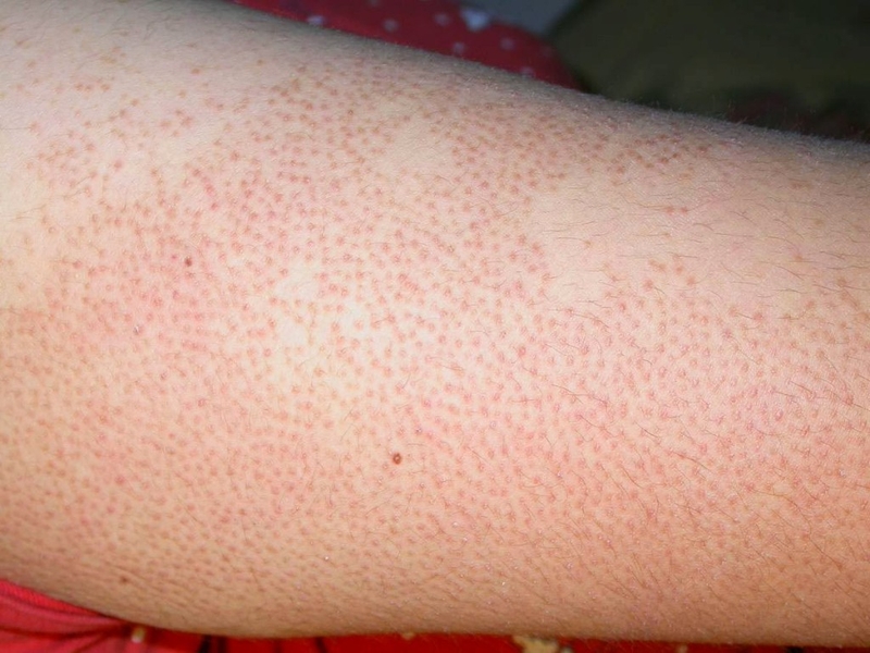 Bệnh mề đay phong nhiệt.