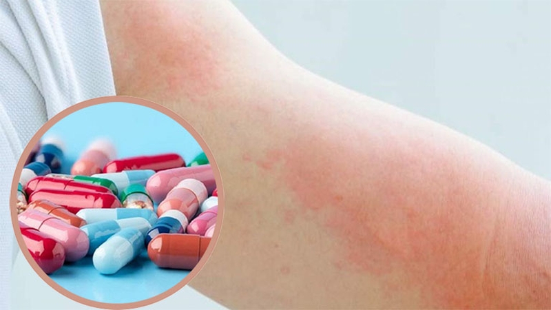 Dùng thuốc Tây&nbsp;điều trị mề đay phong nhiệt.