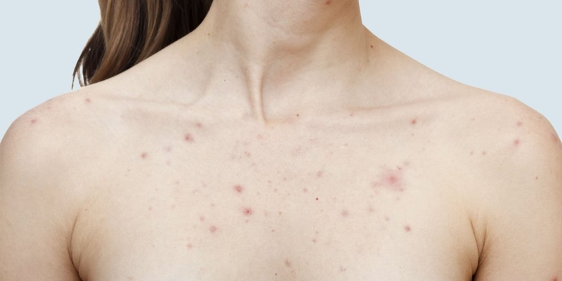 Cách điều trị bệnh sởi ở người lớn bằng phương pháp dân gian 1