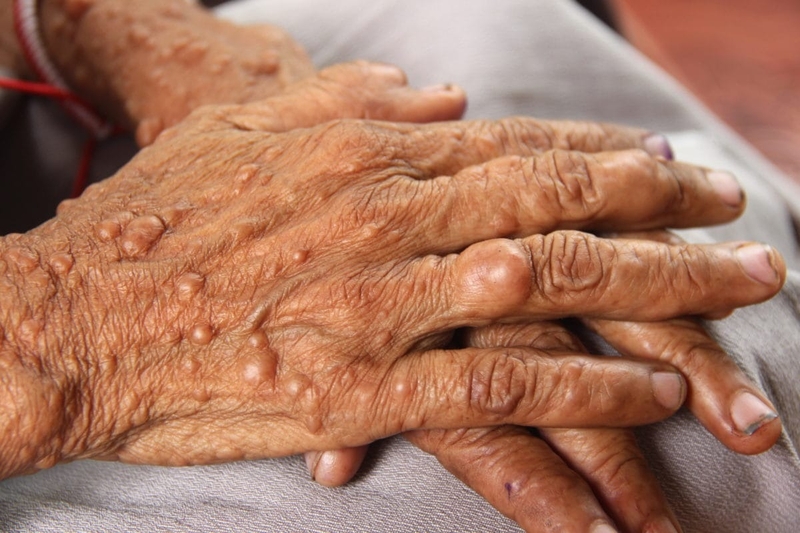 Cách điều trị bệnh u xơ thần kinh? Bệnh có chữa khỏi được không? 1