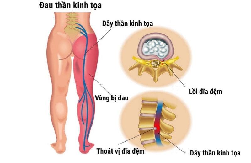 Cách điều trị đau thần kinh tọa do thoát vị đĩa đệm là gì? 1