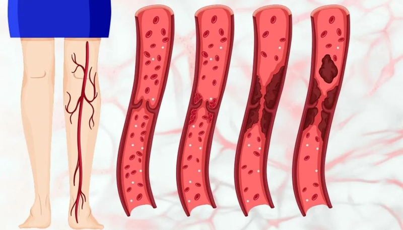 Cách điều trị huyết khối tĩnh mạch: Phương pháp hiệu quả và an toàn 1