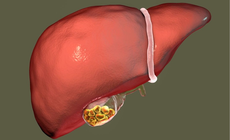 Cách điều trị sỏi đường mật trong gan hiệu quả 1