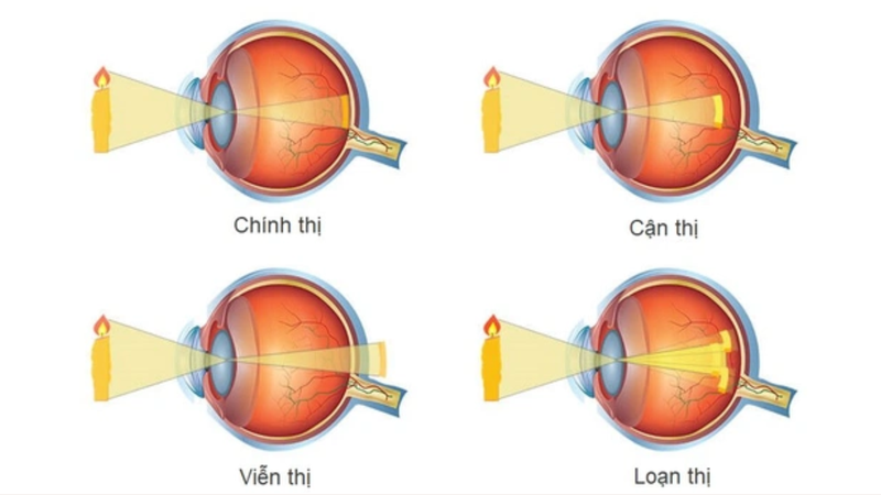 Cách điều trị tật khúc xạ ở trẻ em 1