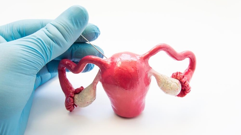 Cách điều trị u nang buồng trứng: Những phương pháp hiệu quả và lưu ý 1