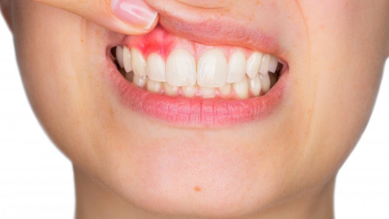 Cách điều trị ung thư nướu răng 2