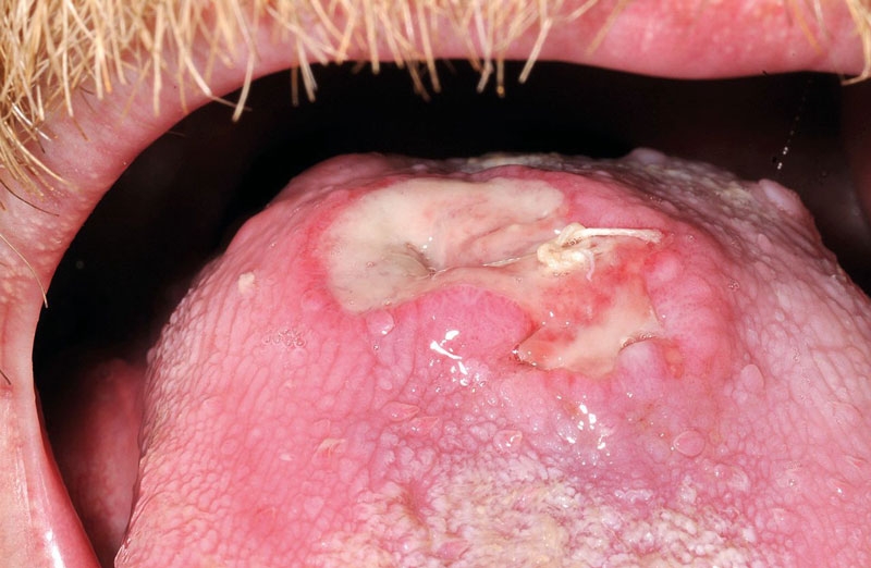 ​  Bệnh nhân cần xét nghiệm để chẩn đoán giang mai 2