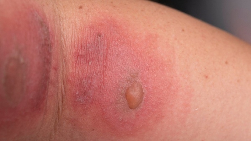 Cách điều trị và phòng ngừa khi bị viêm da tiếp xúc do côn trùng 3