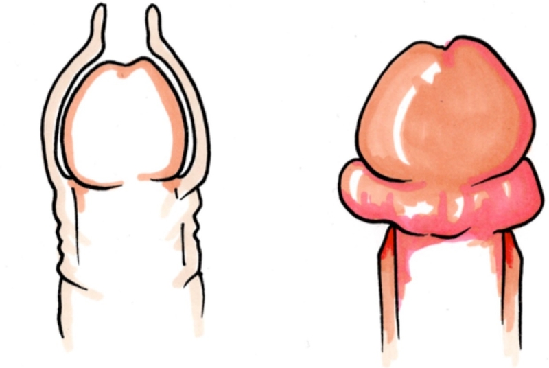 Cách điều trị và phòng ngừa sẹo lồi bao quy đầu 1