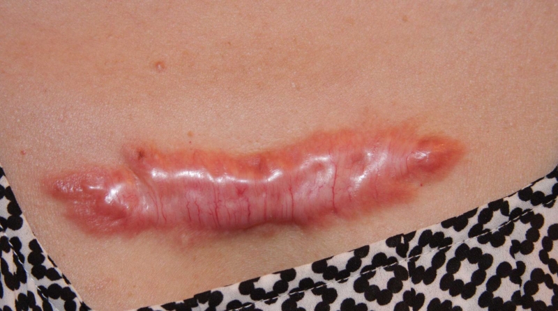 Cách điều trị và phòng ngừa sẹo lồi bao quy đầu 2