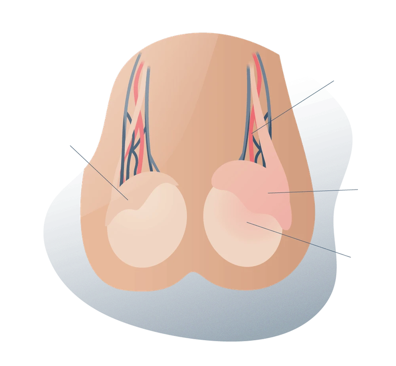 Cách điều trị viêm mào tinh hoàn ở nam giới -1