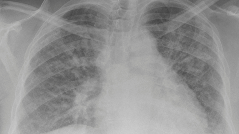 Hướng dẫn quản lý bệnh xơ phổi tại nhà