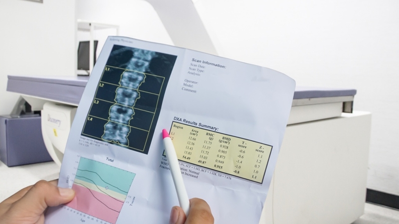 Cách đọc kết quả đo mật độ xương chuẩn xác 1