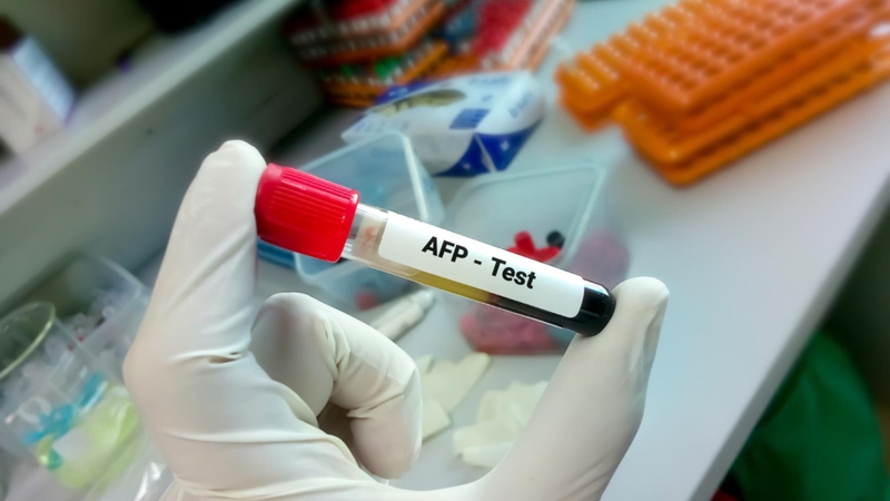 Xét nghiệm AFP được sử dụng trong nhiều tình huống lâm sàng
