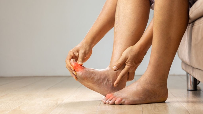 Cách giảm đau gout nhanh nhất mà bạn nên biết 1