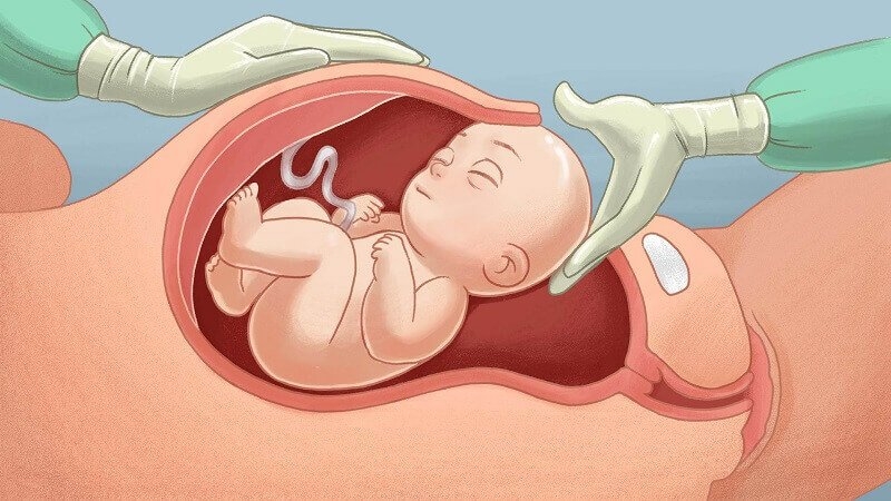 Mẹ bầu lần 2 muốn sinh mổ trong suốt quá trình thai kỳ nên bổ sung dinh dưỡng đầy đủ, tránh stress