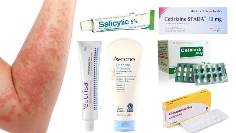 cách giảm ngứa khi bị chàm 4