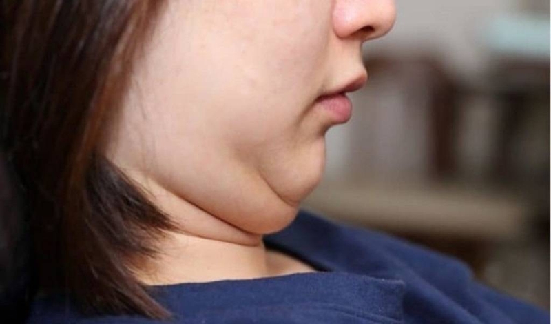 Cách giảm nọng cằm cấp tốc dễ áp dụng hàng ngày