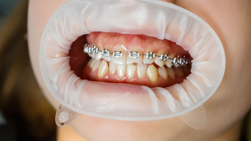 Cách giữ răng trắng khi niềng răng là vệ sinh đúng cách và khám nha khoa định kỳ