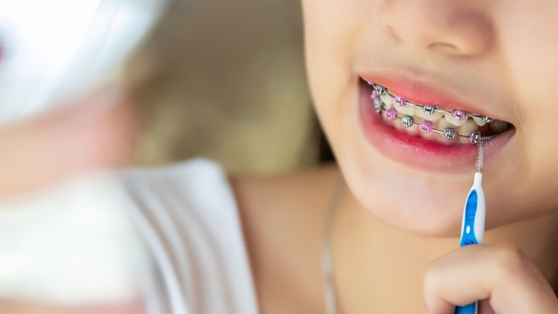 Làm sạch răng đúng cách giúp hạn chế mảng bám quanh mắc cài