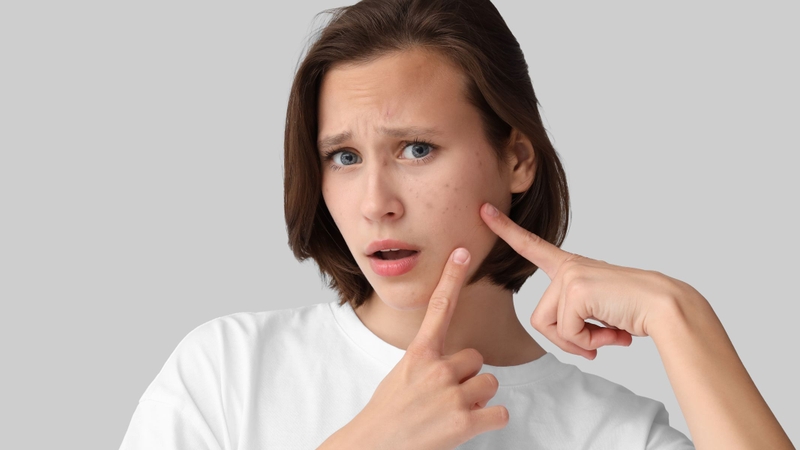 Mụn cám là dạng mụn nhỏ, thường xuất hiện thành từng vùng trên da do sự tích tụ của dầu thừa