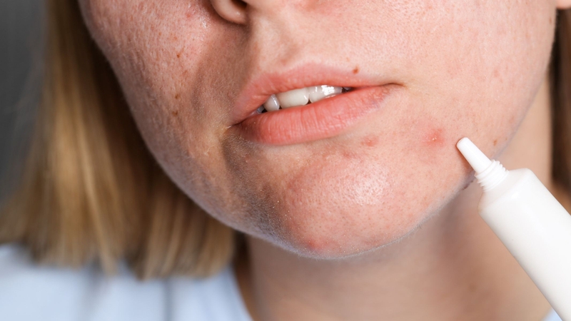 Điều trị bằng Benzoyl peroxide là cách hết mụn an toàn