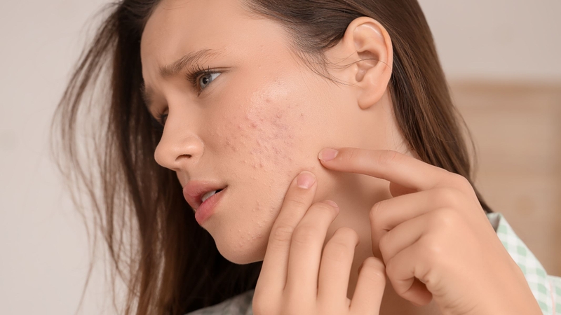 Có nên nặn mụn không?