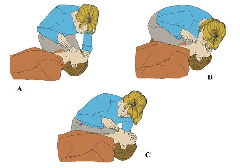 Quy trình sơ cứu bỏng đường hô hấp giúp hạn chế tổn thương 3