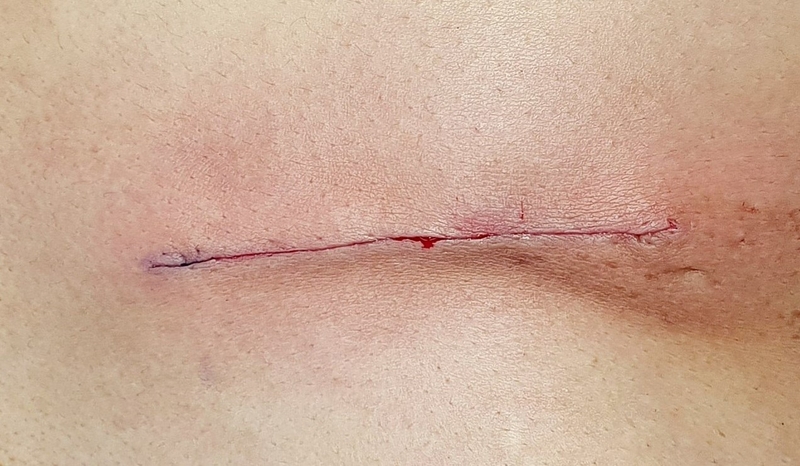 Cách khắc phục sẹo lồi ngày càng to 3