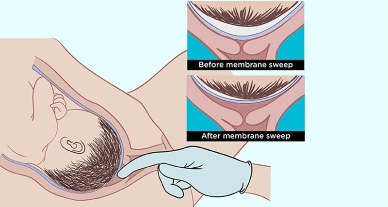 Cách kích thích chuyển dạ khi quá ngày dự sinh và những điều cần lưu ý 2