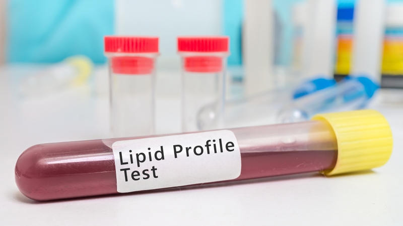 Xét nghiệm tại cơ sở y tế giúp đánh giá Cholesterol toàn phần, LDL, HDL và Triglycerides