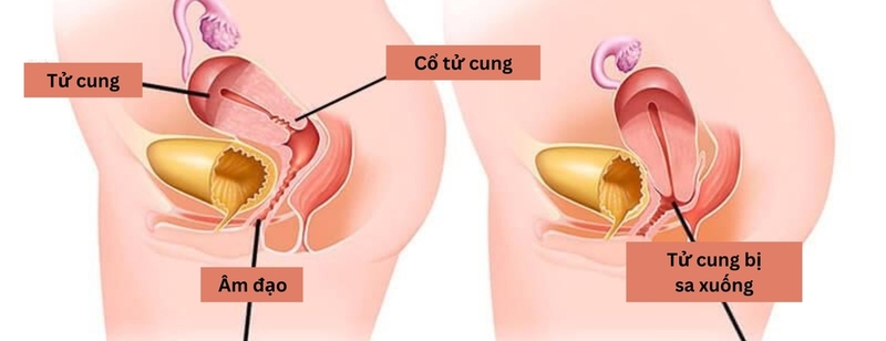 Cách kiểm tra sa tử cung, hướng xử trí và các biện pháp phòng ngừa sa tử cung 1