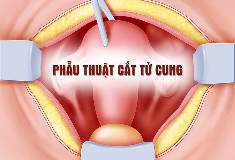 Cách kiểm tra sa tử cung, hướng xử trí và các biện pháp phòng ngừa sa tử cung 3