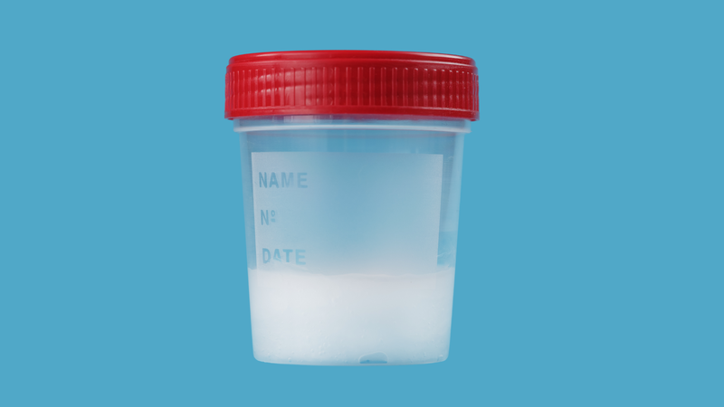 Tinh dịch đồ hỗ trợ bác sĩ đánh giá nguyên nhân gây vô sinh nam