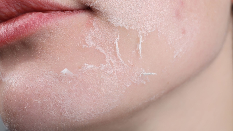 Tuyệt đối không được tự ý dùng tay bóc các mảng da bị bong ra khiên da bị viêm