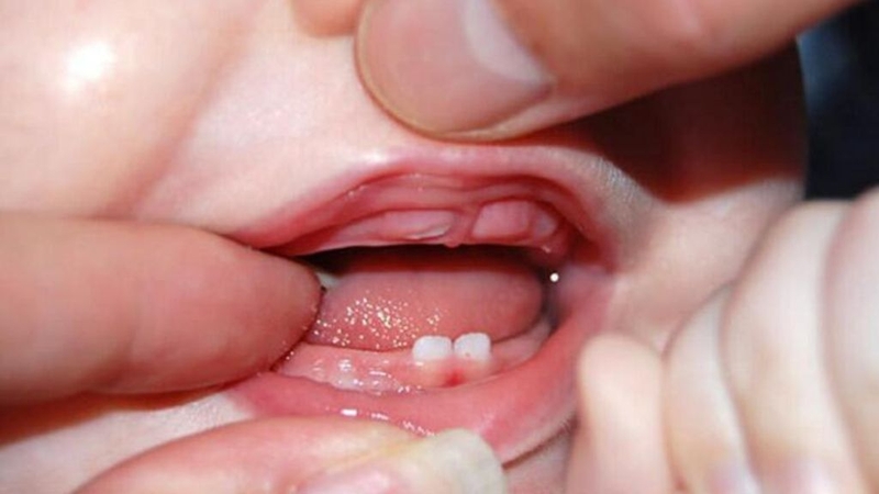 Cách làm cho răng mọc nhanh nhất ở trẻ là gì? Chăm sóc như thế nào? 1