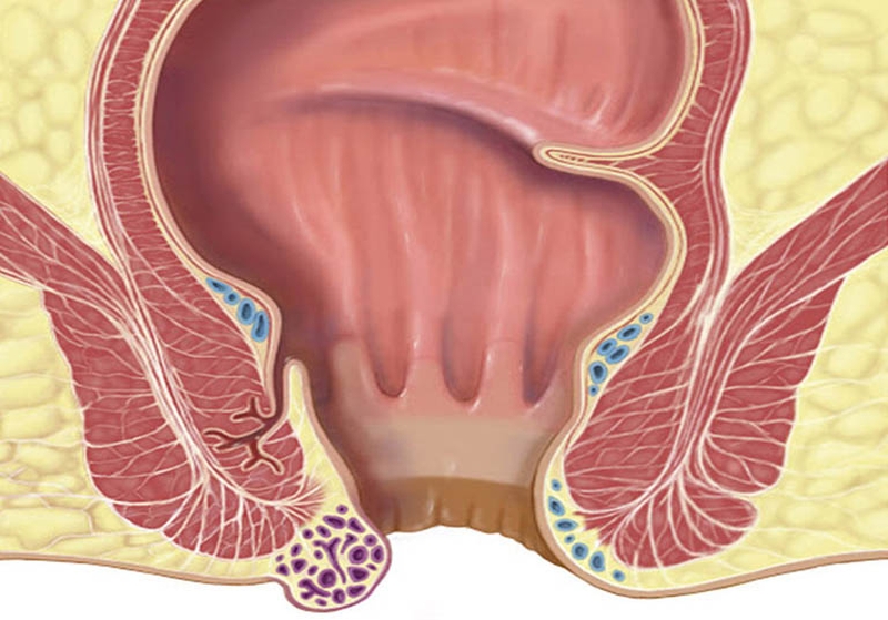 Cách làm co búi trĩ ngoại đơn giản, an toàn bạn nên biết 1