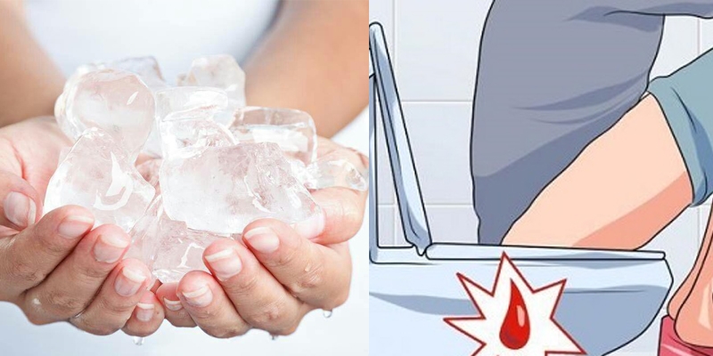 Cách làm co búi trĩ ngoại đơn giản, an toàn bạn nên biết 2