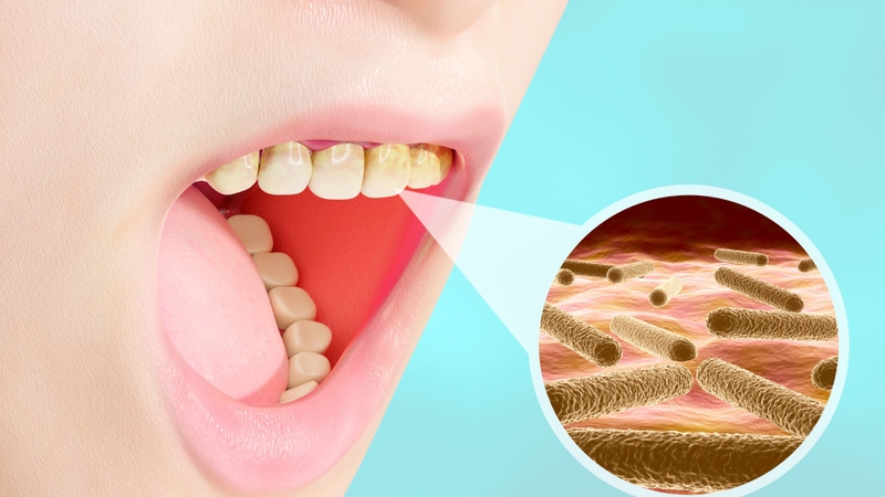 Cách làm giảm sưng nướu răng khôn, hạn chế đau nhức 3