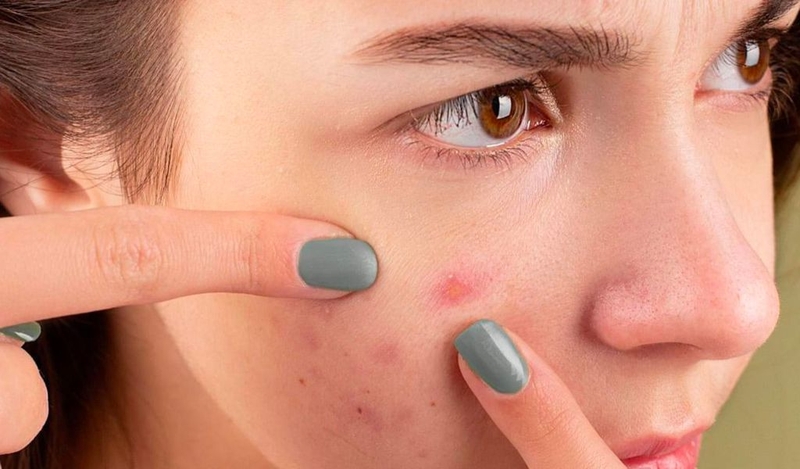 Cách làm mụn bọc nhanh chín đơn giản, hiệu quả và lành tính 1