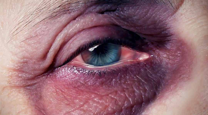 Mách nhỏ bạn cách làm tan máu bầm ở mắt 1