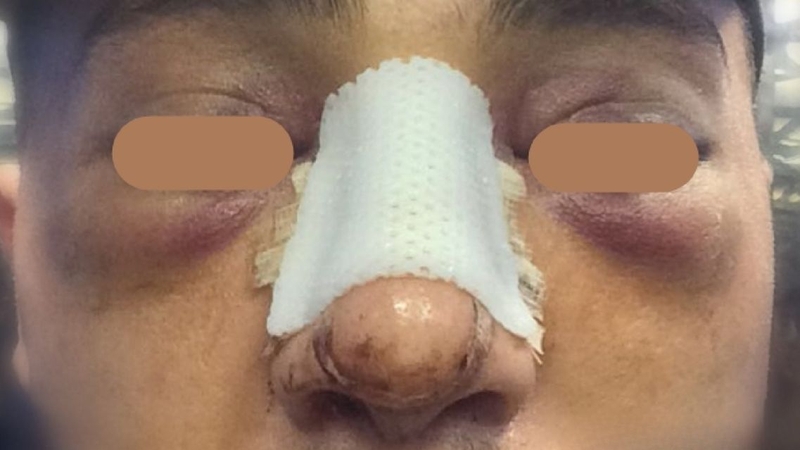 Tìm hiểu&nbsp;cách làm tan máu bầm sau nâng mũi là việc cần thiết