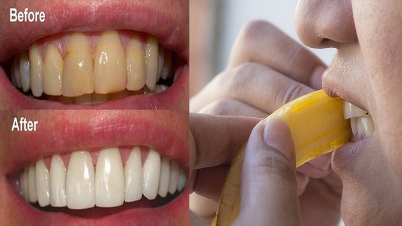 Cách làm trắng răng bằng vỏ chuối đơn giản