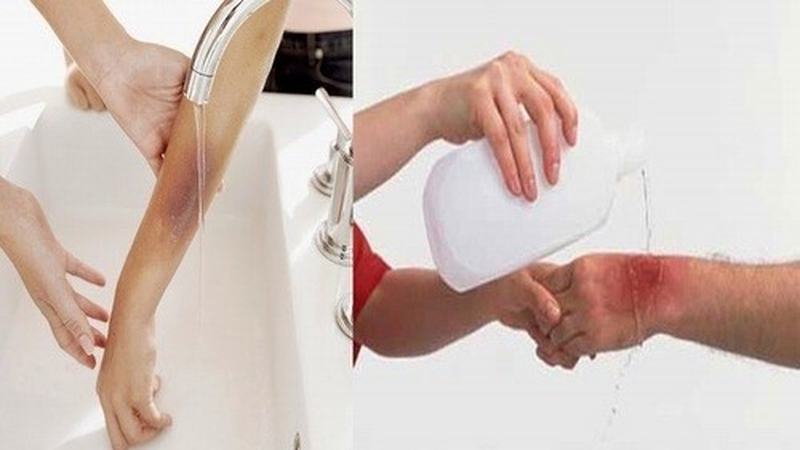 Cách làm vết bỏng nhanh khô 3