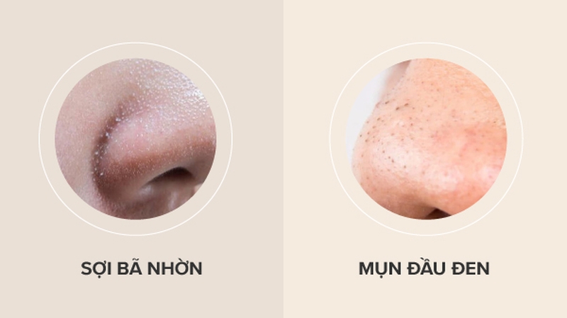 Phân biệt sợi bã nhờn và mụn đầu đen